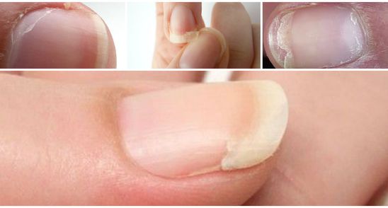 Ai unghii exfoliate si rupte? Ce sa faci in acest caz