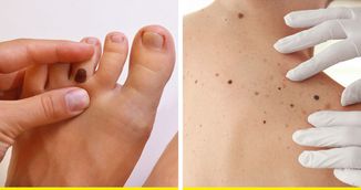In ce zone ale corpului apare cel mai des cancerul de piele