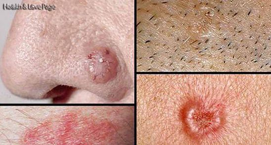 Astea sunt semnele surprinzatoare care iti spun ca deja ai celule canceroase in corp!