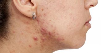 Greseli aparent inofensive care inrautatesc acneea