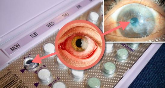 Specialistii anunta: Anticonceptionalele duc la orbire! Cum este posibil