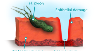 Reteta care elimina bacteria Helicobacter Pylori fara antibiotice. Face adevarate minuni