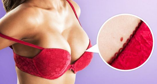 Ai asemenea puncte rosii pe piele? Uite ce reprezinta mai exact si cat sunt de periculoase!