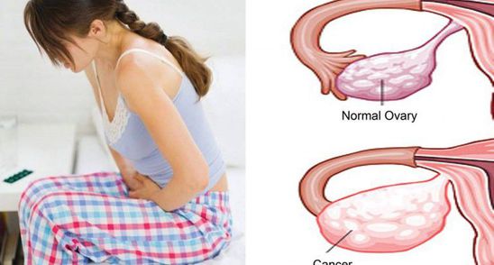 Acestea sunt cele doua semne importante care iti spun ca ai putea cancer la ovare. Fii foarte atenta