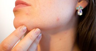 Scapa pentru totdeauna de dermatita cu aceste patru remedii naturale!