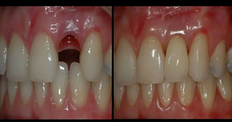 Descoperirea care revolutioneaza medicina dentara: Dinti regenerati complet in doar 8 saptamani