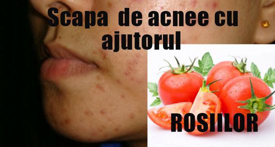 Rosiile, solutia rapida pentru a scapa de acnee. Ce trebuie sa faci