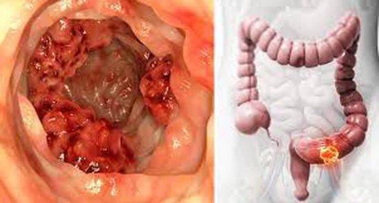 Uleiul incredibil care distruge 90% din celulele de cancer la colon. Trebuie sa il ai in casa
