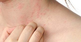 Suferi de eczeme? Incearca aceste tratament naturiste uluitoare