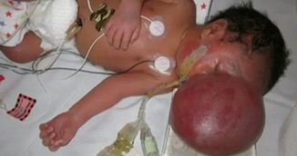 Copilul asta s-a nascut cu creierul in afara craniului! Trebuie sa vezi cum arata acum, dupa o operatie de sase ore care i-a salvat viata!