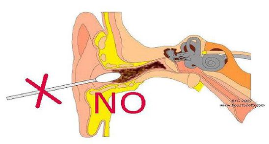 Trucurile care te scapa de cerumen la tine acasa. Sunt simple si rapide