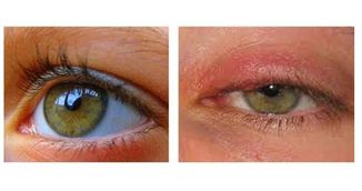 Remediu natural incredibil care iti vindeca infectiile ochilor in 24 de ore!