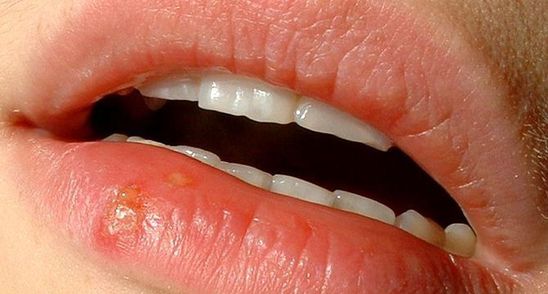 Ti-a aparut un herpes peste noapte? Uite cum scapi rapid de el cu remedii naturiste